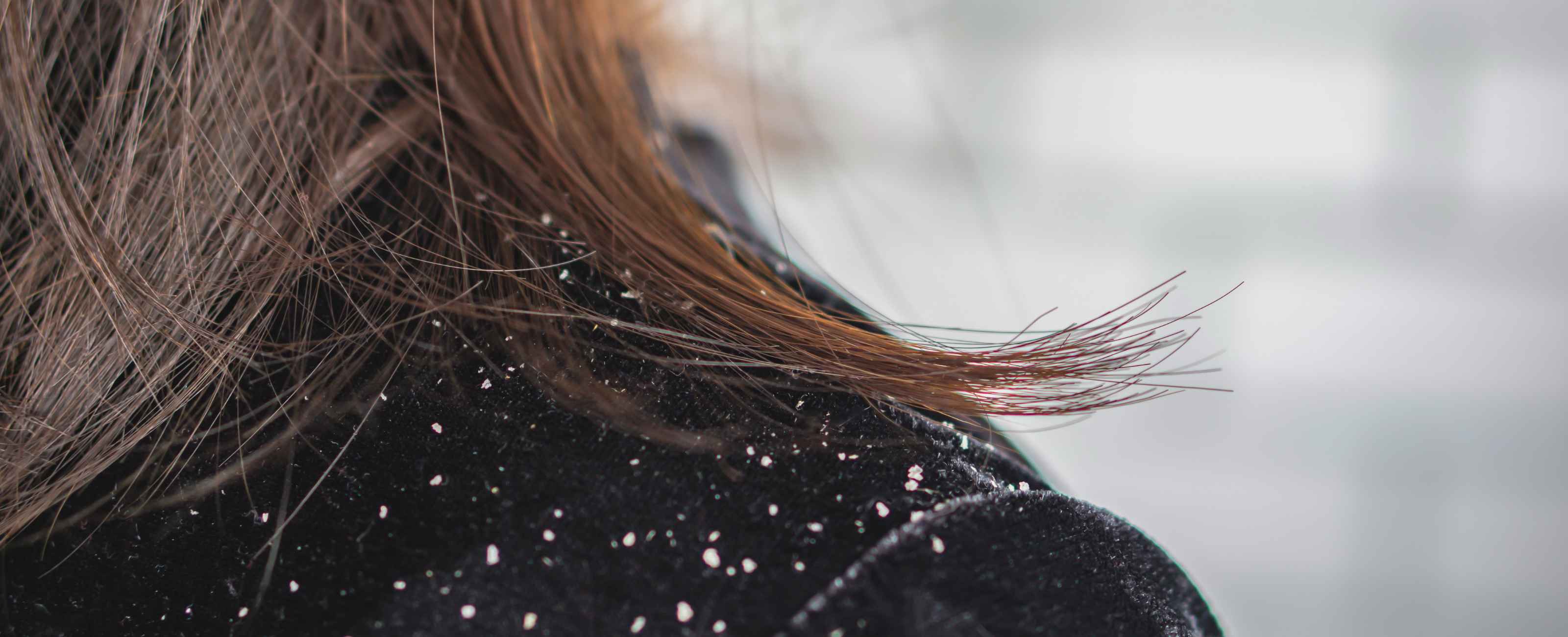 Adoptez de bons réflexes pour prévenir les pellicules !