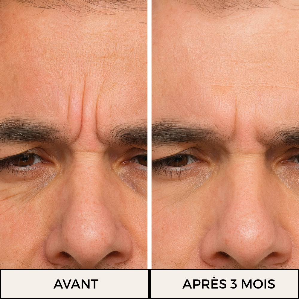 Visuel avant / après rides du lion (homme)
Résultats après 3 mois de cure Collagène Reggenerate Délicure : atténuation visible des rides du lion et amélioration de la fermeté cutanée.