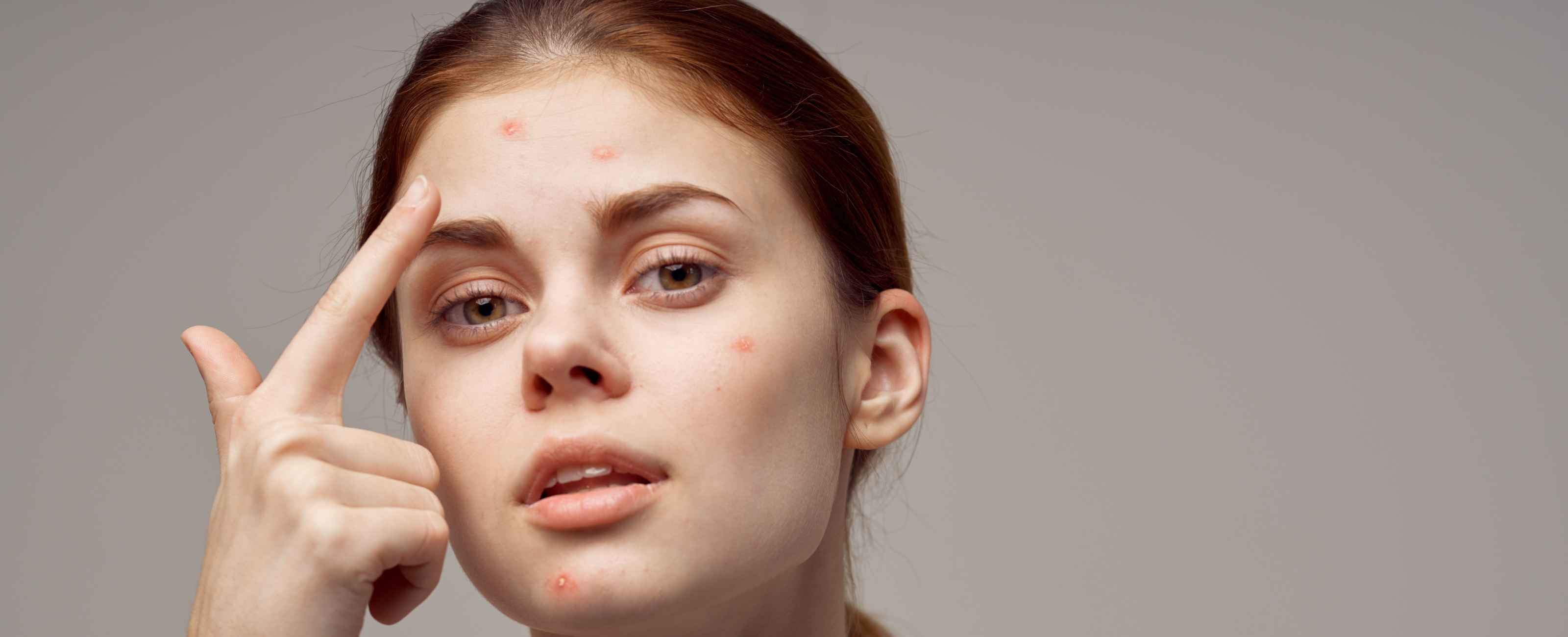 Astuces pour prévenir et faire disparaitre l'acné.