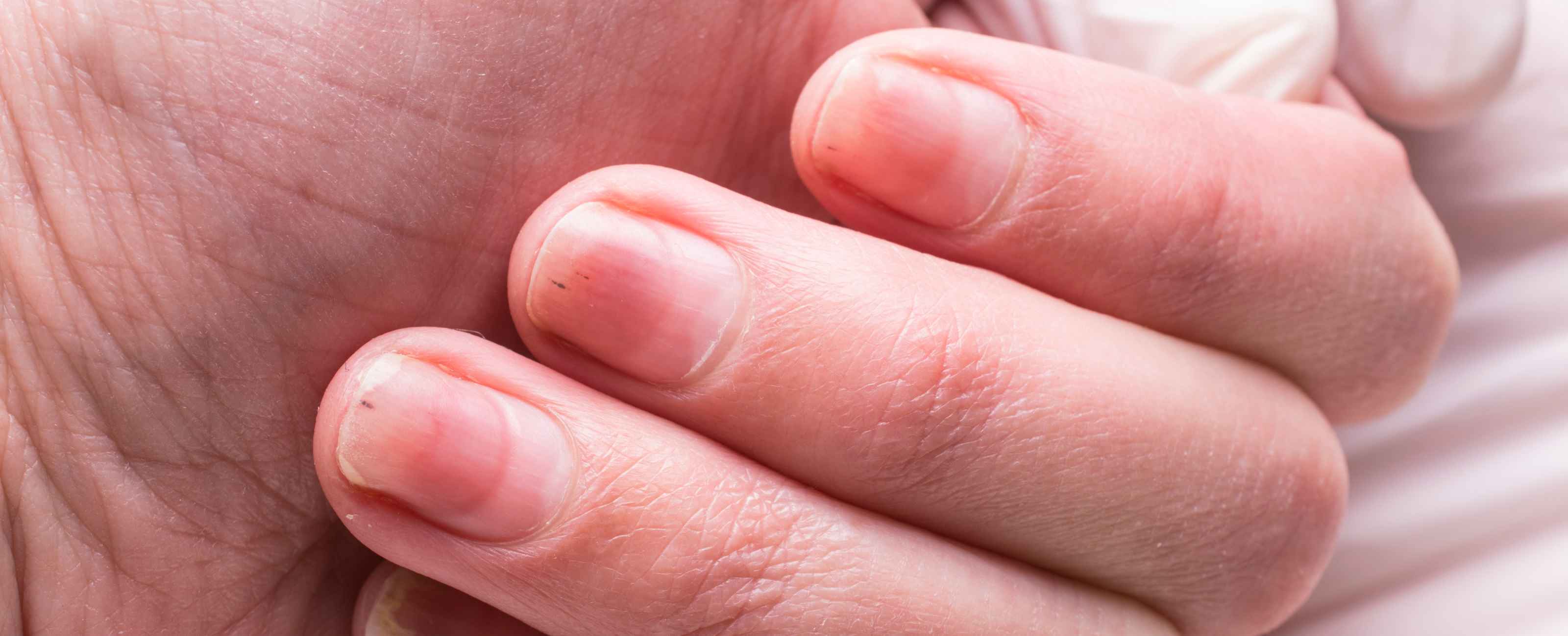 Mycose des ongles : comment s'en débarrasser pour toujours et naturellement