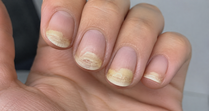 photo d'ongles de la main atteints d'onycholyse